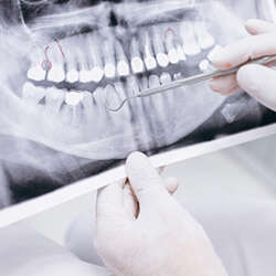x-ray-teeth_1303-9353